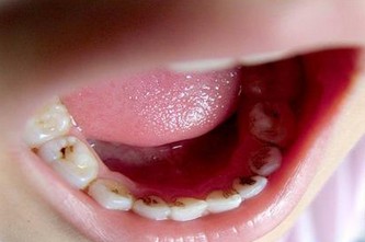 牙釉质发育不全
