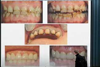 牙釉质的治疗方法