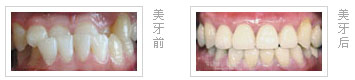 地包天牙齿矫正年龄更佳期