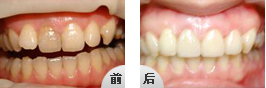 牙齿是四环素牙做瓷贴面还是树脂贴面