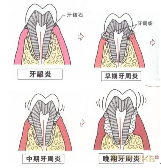 牙周炎和牙龈炎的症状有哪些