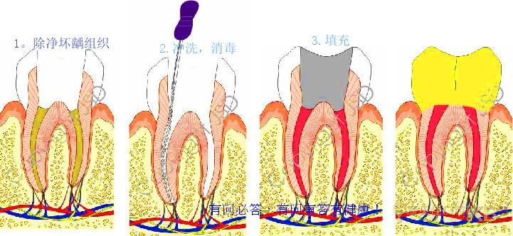 根管治疗