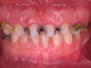 蛀牙牙痛怎么快速止痛准确果